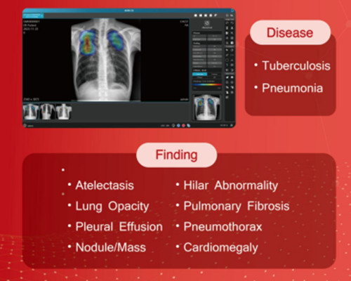 Portable Digital X-ray System with AI_High-Performance AI-Assisted Screening for Accurate Diagnosis_SGSC