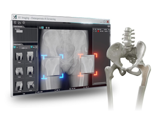 Osteoporosis AI Screening Solution_Efficient Screening with Rapid AI Report Generation_SGSC