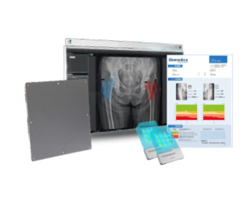 Osteoporosis AI Screening Solution_Efficient Image Analysis for Enhanced Screening Workflow_SGSC